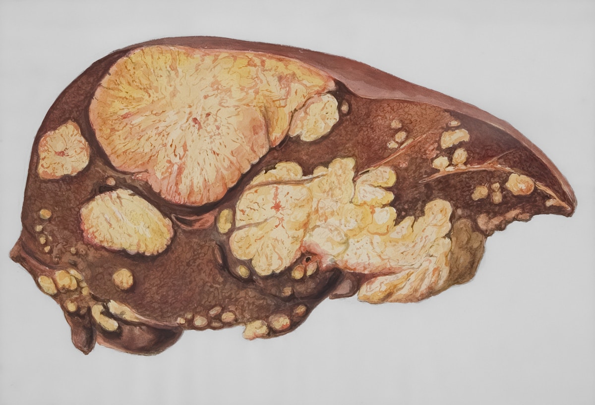 Naturally occurring hormone discovered to shield the liver from inflammation and scarring