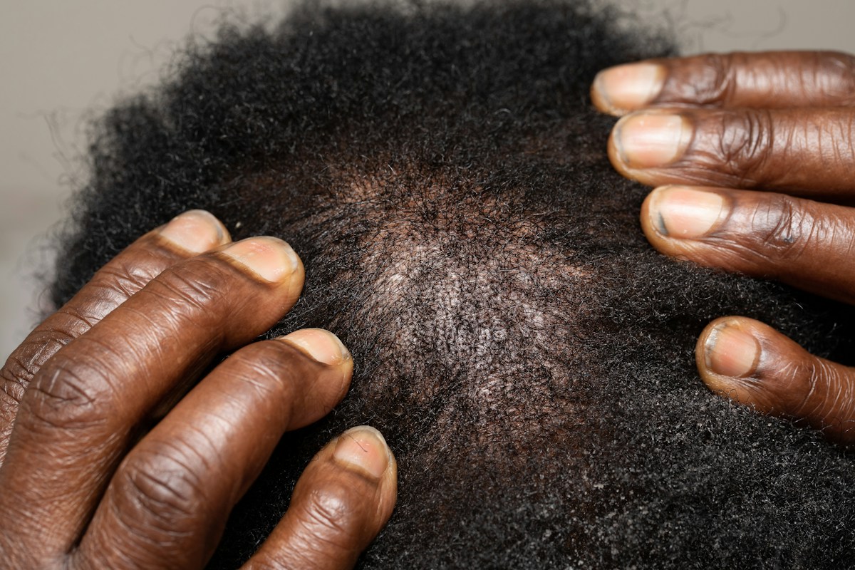 Common Arthritis Treatment Offers New Hope for Millions with Severe Hair Loss